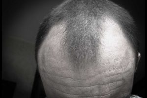 Regrow and stop baldness with effective solutions for your hair